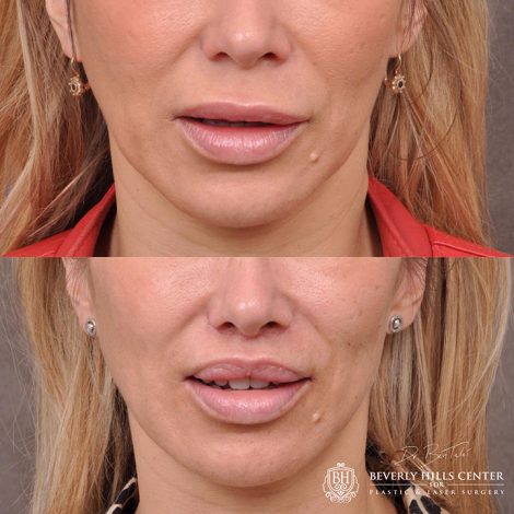 Modified Upper Lip Lift - Front