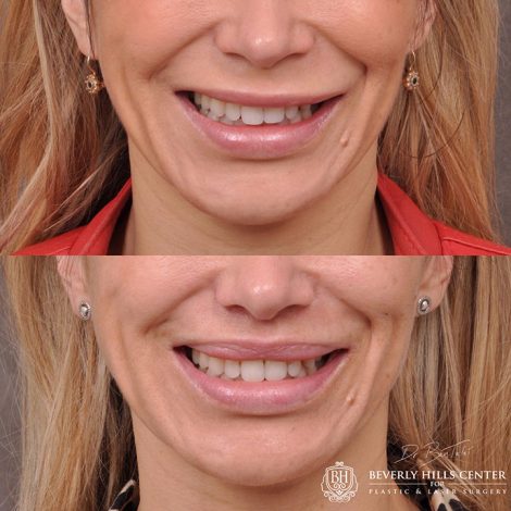 Modified Upper Lip Lift - Front
