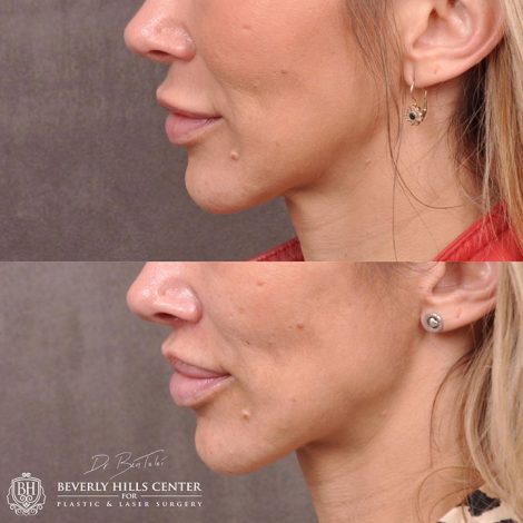 Modified Upper Lip Lift - Left Side