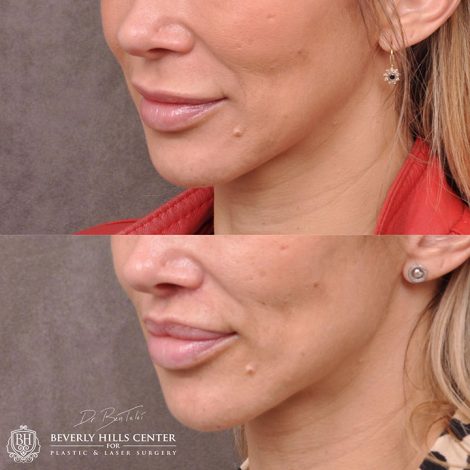 Modified Upper Lip Lift - Left Side