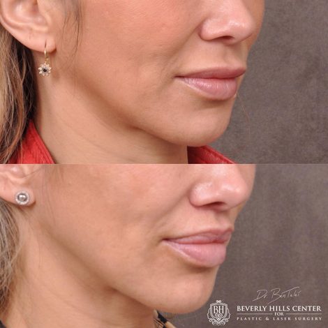 Modified Upper Lip Lift - Right Side