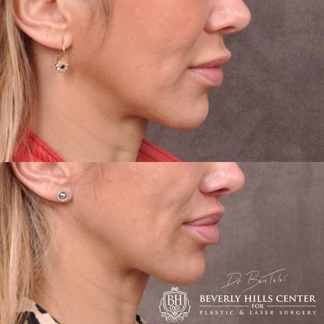 Modified Upper Lip Lift - Right Side