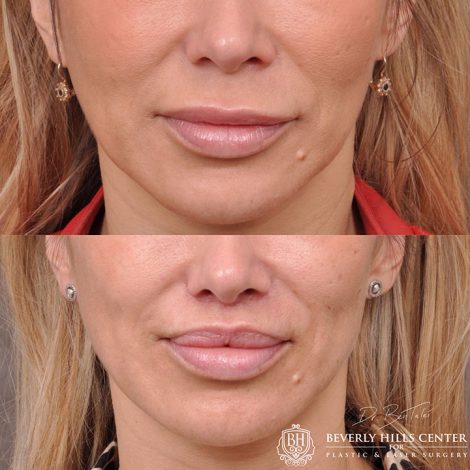 Modified Upper Lip Lift - Front
