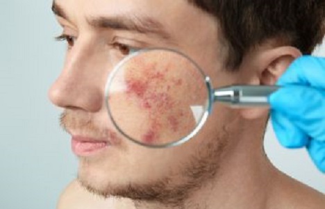 Young Man with Severe Acne