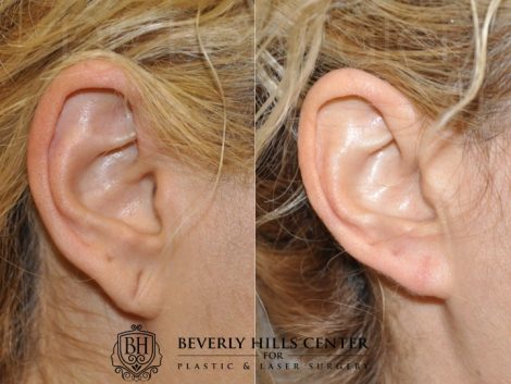 Beverly Hills Center Female Patient Before and After Stretched Ear Lobe Repair