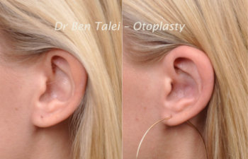 Patient Before and After Otoplasty Beverly Hills CA