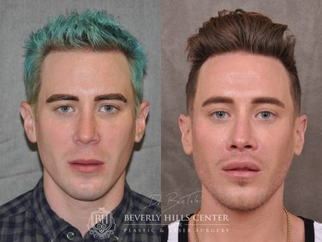 Modified Upper Lip Lift for Men - Front