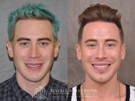 Modified Upper Lip Lift for Men - Front