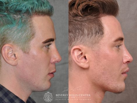Modified Upper Lip Lift for Men - Right Side
