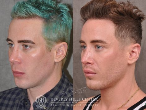 Modified Upper Lip Lift for Men - Left Side