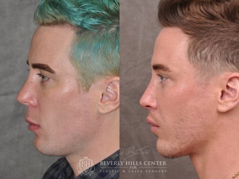 Modified Upper Lip Lift for Men - Left Side