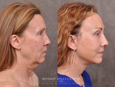 AuraLyft with upper blepharoplasty using fat repositioning, lower lid blepharoplasty with fat repositioning and CO2 laser resurfacing - Right Side