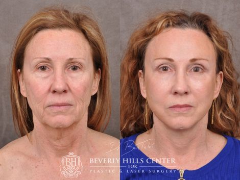 AuraLyft with upper blepharoplasty using fat repositioning, lower lid blepharoplasty with fat repositioning and CO2 laser resurfacing - Front