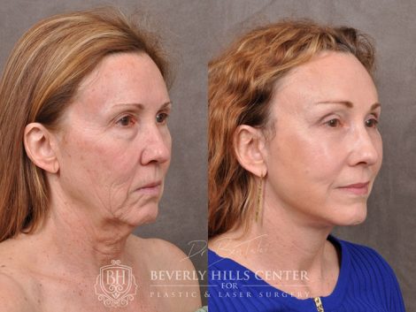 AuraLyft with upper blepharoplasty using fat repositioning, lower lid blepharoplasty with fat repositioning and CO2 laser resurfacing - Right Side