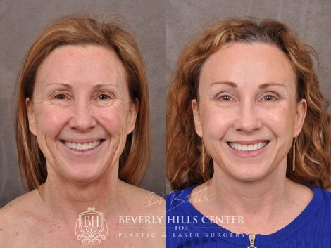 AuraLyft with upper blepharoplasty using fat repositioning, lower lid blepharoplasty with fat repositioning and CO2 laser resurfacing - Front