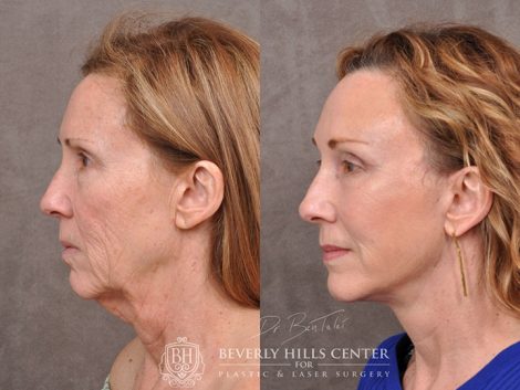 AuraLyft with upper blepharoplasty using fat repositioning, lower lid blepharoplasty with fat repositioning and CO2 laser resurfacing - Left Side