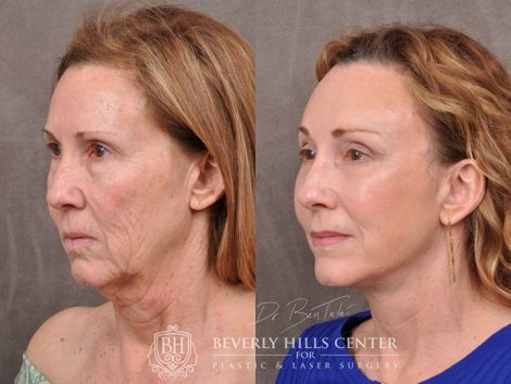 AuraLyft with upper blepharoplasty using fat repositioning, lower lid blepharoplasty with fat repositioning and CO2 laser resurfacing - Left Side