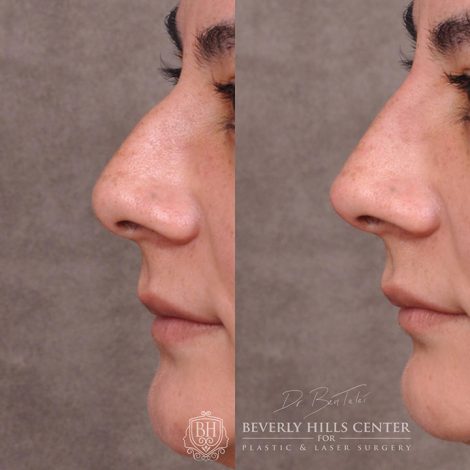 Beverly Hills Center Female Patient Before and After Non-surgical Rhinoplasty