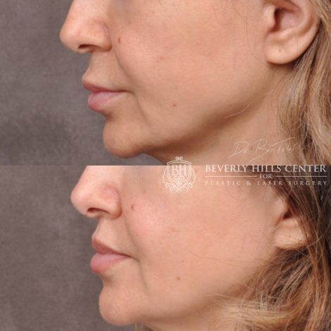 Modified Upper Lip Lift