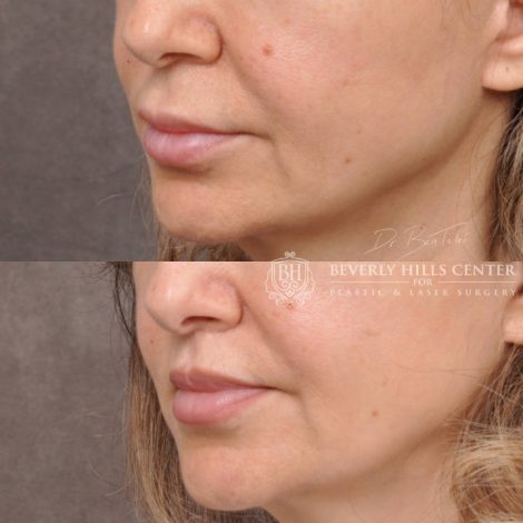 Modified Upper Lip Lift
