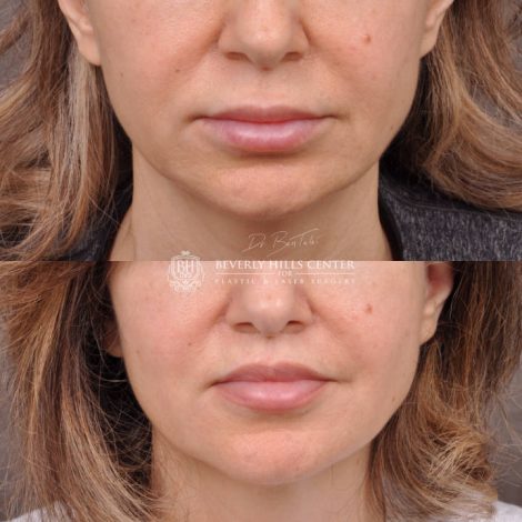 Modified Upper Lip Lift