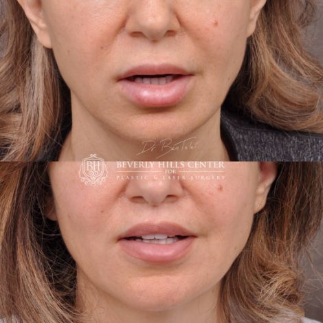 Modified Upper Lip Lift