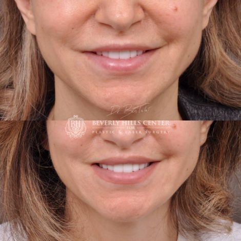 Modified Upper Lip Lift