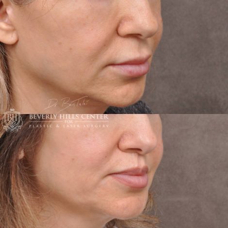 Modified Upper Lip Lift