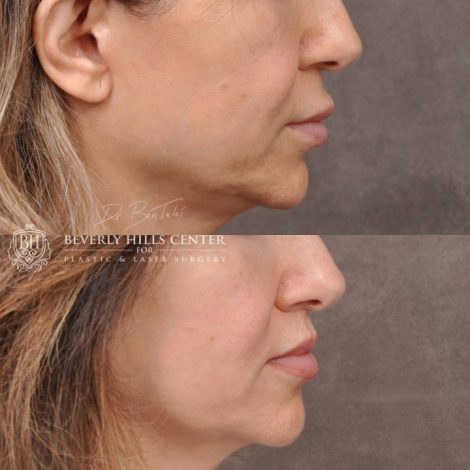 Modified Upper Lip Lift