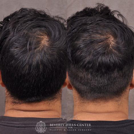 Beverly Hills Center Male Patient Before and After PHAT Hair Treatment