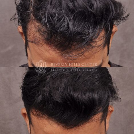 Beverly Hills Center Male Patient Before and After PHAT Hair Treatment