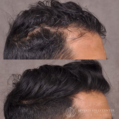 Beverly Hills Center Male Patient Before and After PHAT Hair Treatment