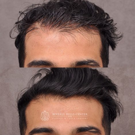 Beverly Hills Center Male Patient Before and After PHAT Hair Treatment