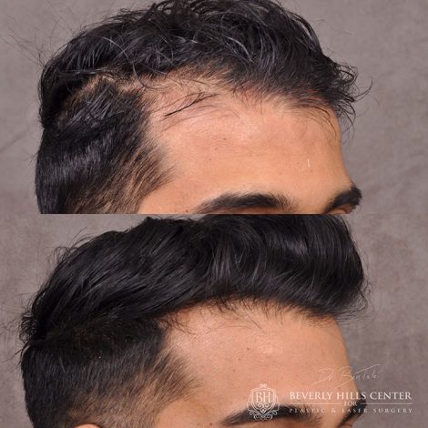 Beverly Hills Center Male Patient Before and After PHAT Hair Treatment