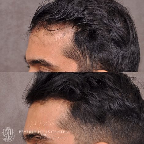 Beverly Hills Center Male Patient Before and After PHAT Hair Treatment