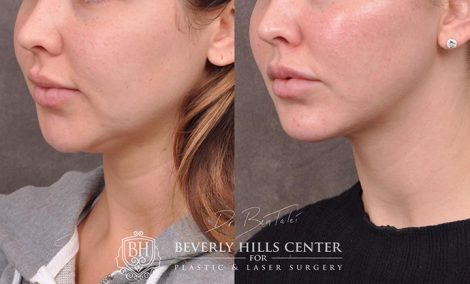 Weekend Necklift - Left Side
