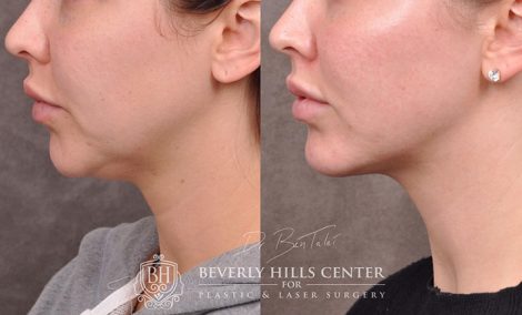 Weekend Necklift - Left Side