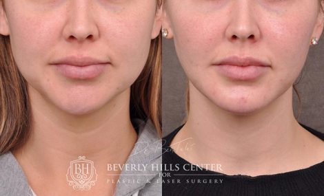Weekend Necklift - Front