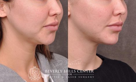 Weekend Necklift - Right Side