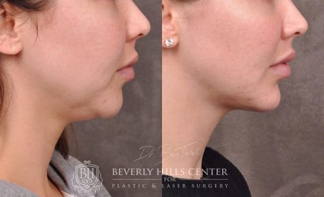 Weekend Necklift - Right Side