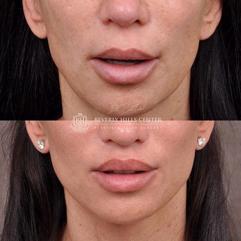 Modified Upper Lip Lift - Front