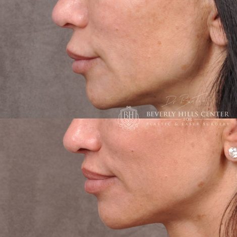 Modified Upper Lip Lift - Left Side