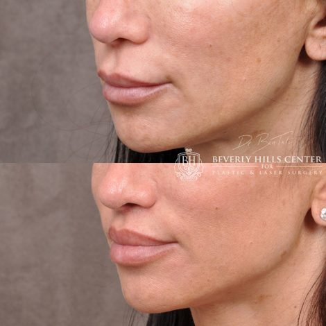 Modified Upper Lip Lift - Left Side