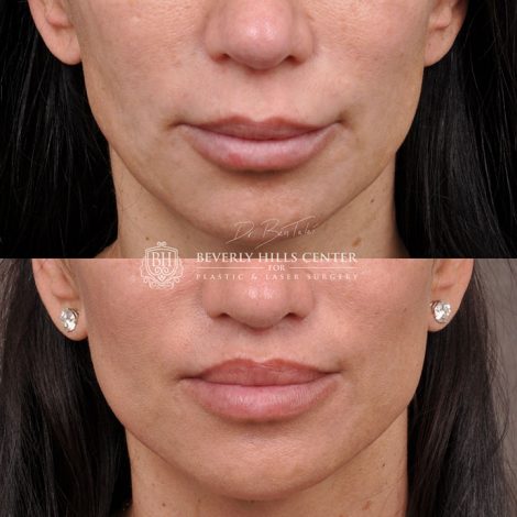 Modified Upper Lip Lift - Front