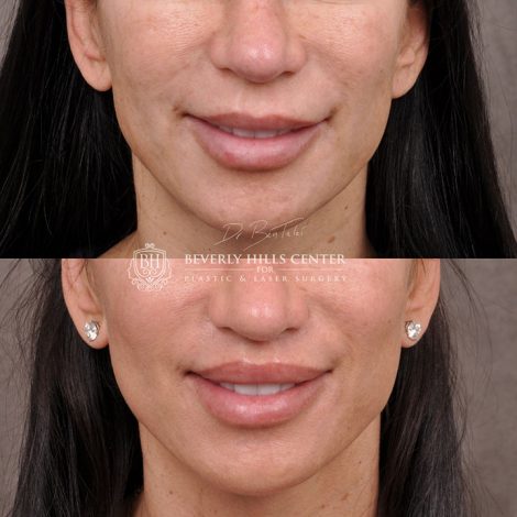 Modified Upper Lip Lift - Front