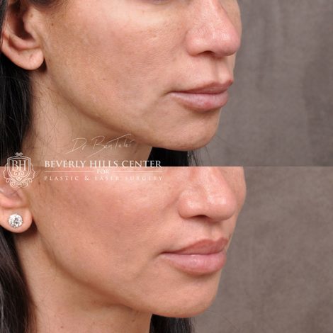 Modified Upper Lip Lift - Right Side