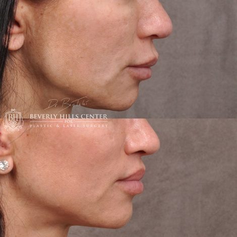 Modified Upper Lip Lift - Right Side