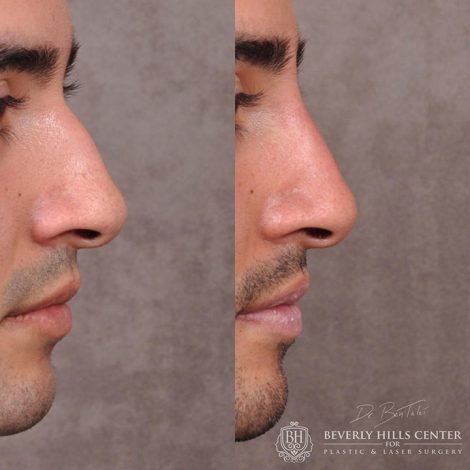 Beverly Hills Center Male Patient Before and After Non Surgical Rhinoplasty Procedure