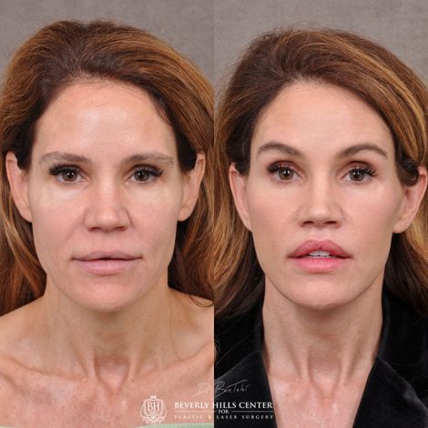AuraLyft & Lip Lift with corner release - Front