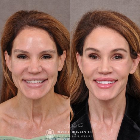 AuraLyft & Lip Lift with corner release - Front